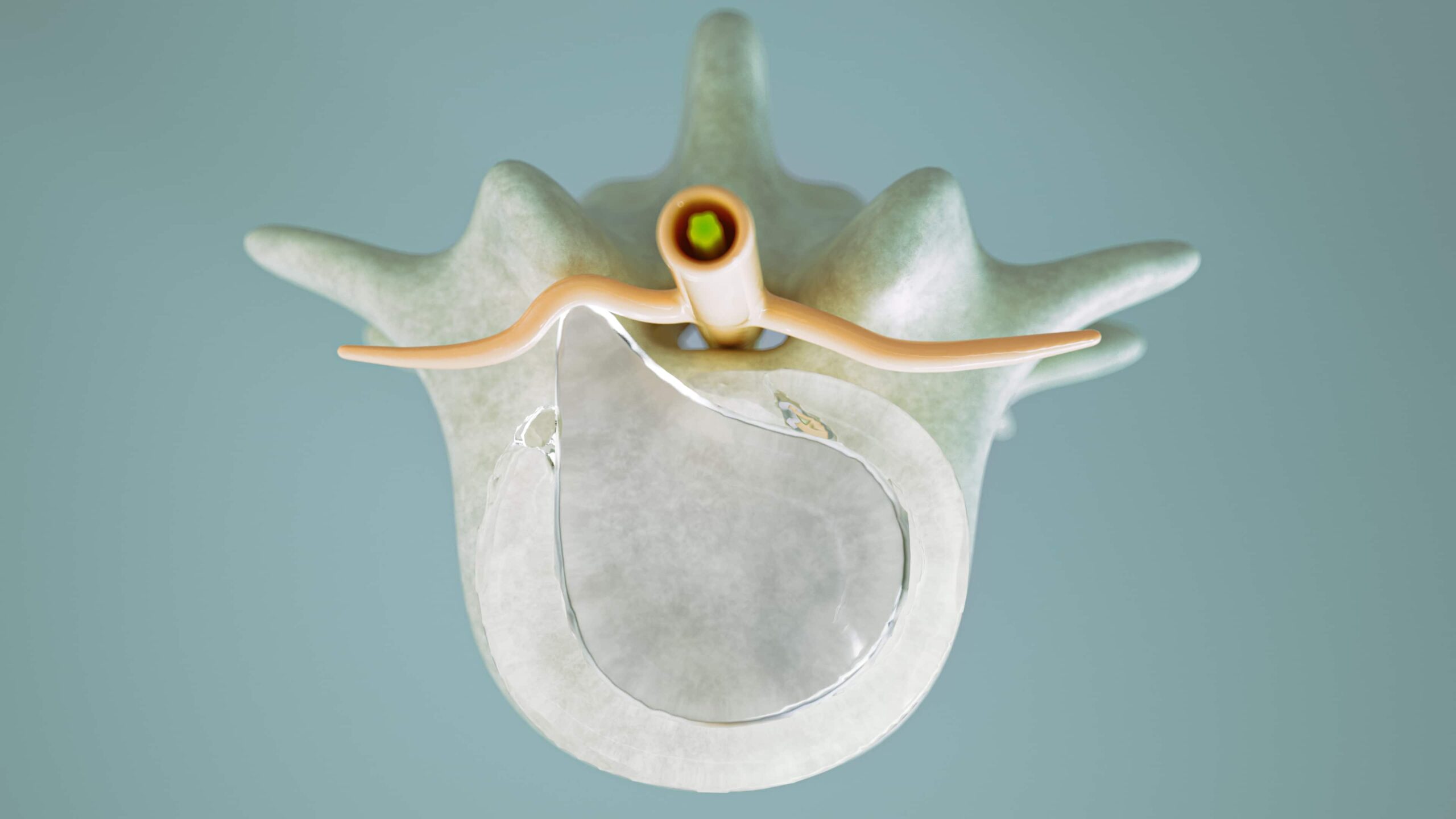 Ilustração 3D detalhando a estrutura anatômica afetada pela protusão discal