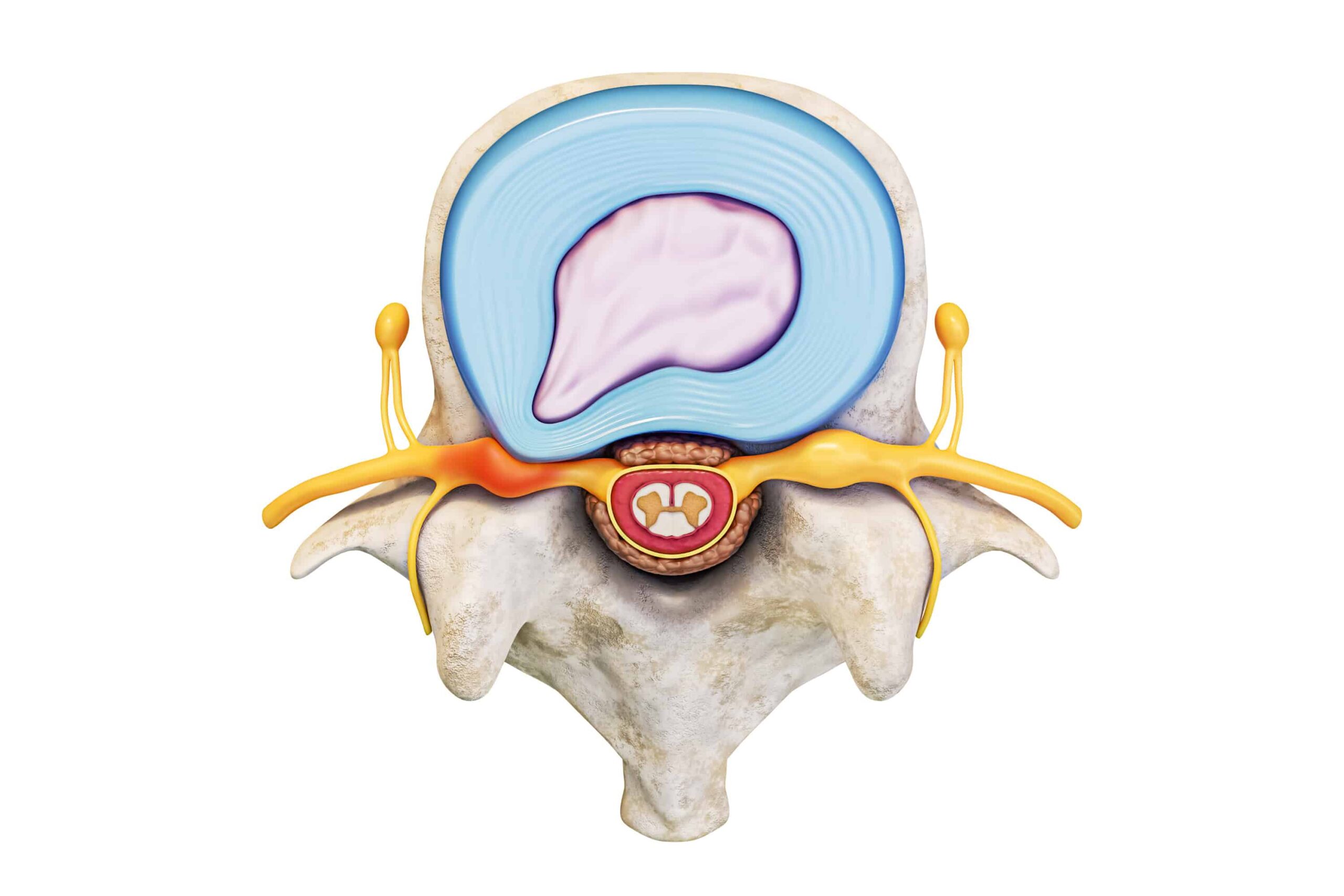 Representação visual da diferença entre protusão discal e hérnia de disco comprimindo o nervo