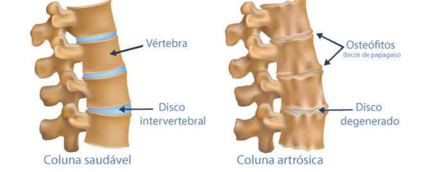 tipos de coluna, com e sem artrose