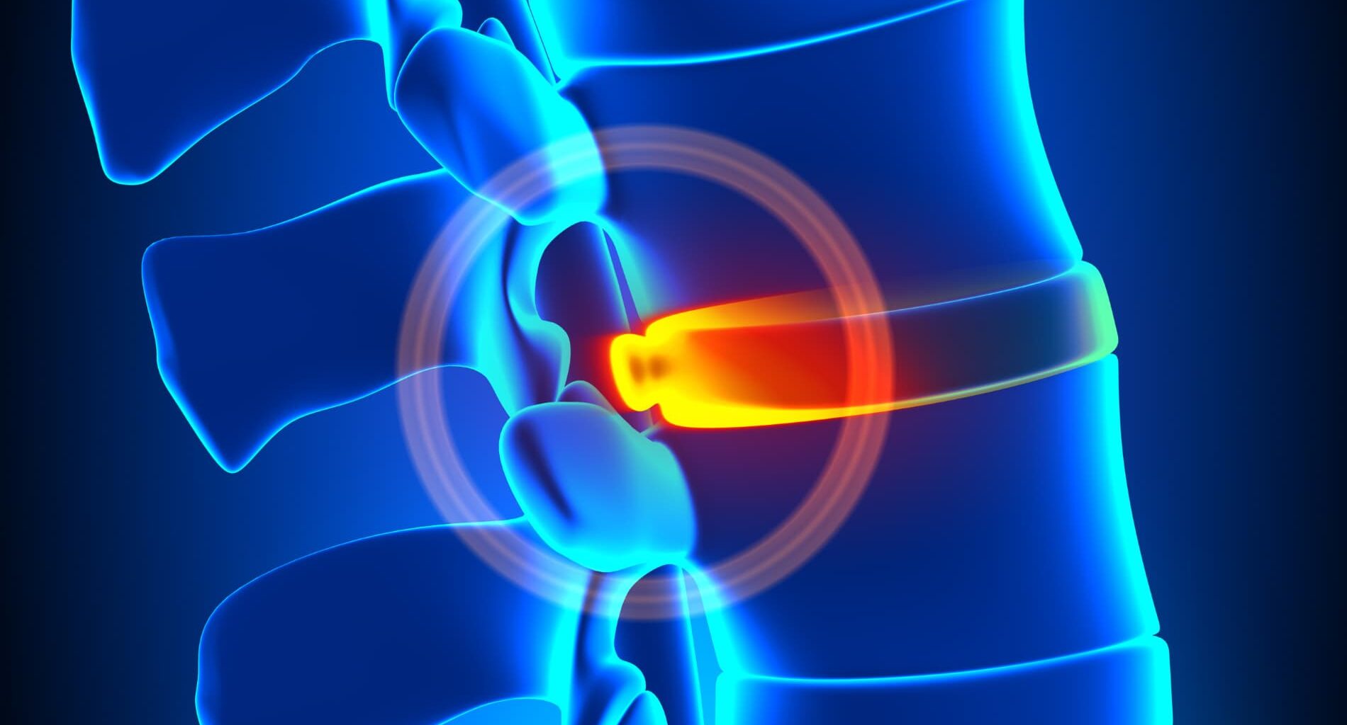 foto de degeneração discal
