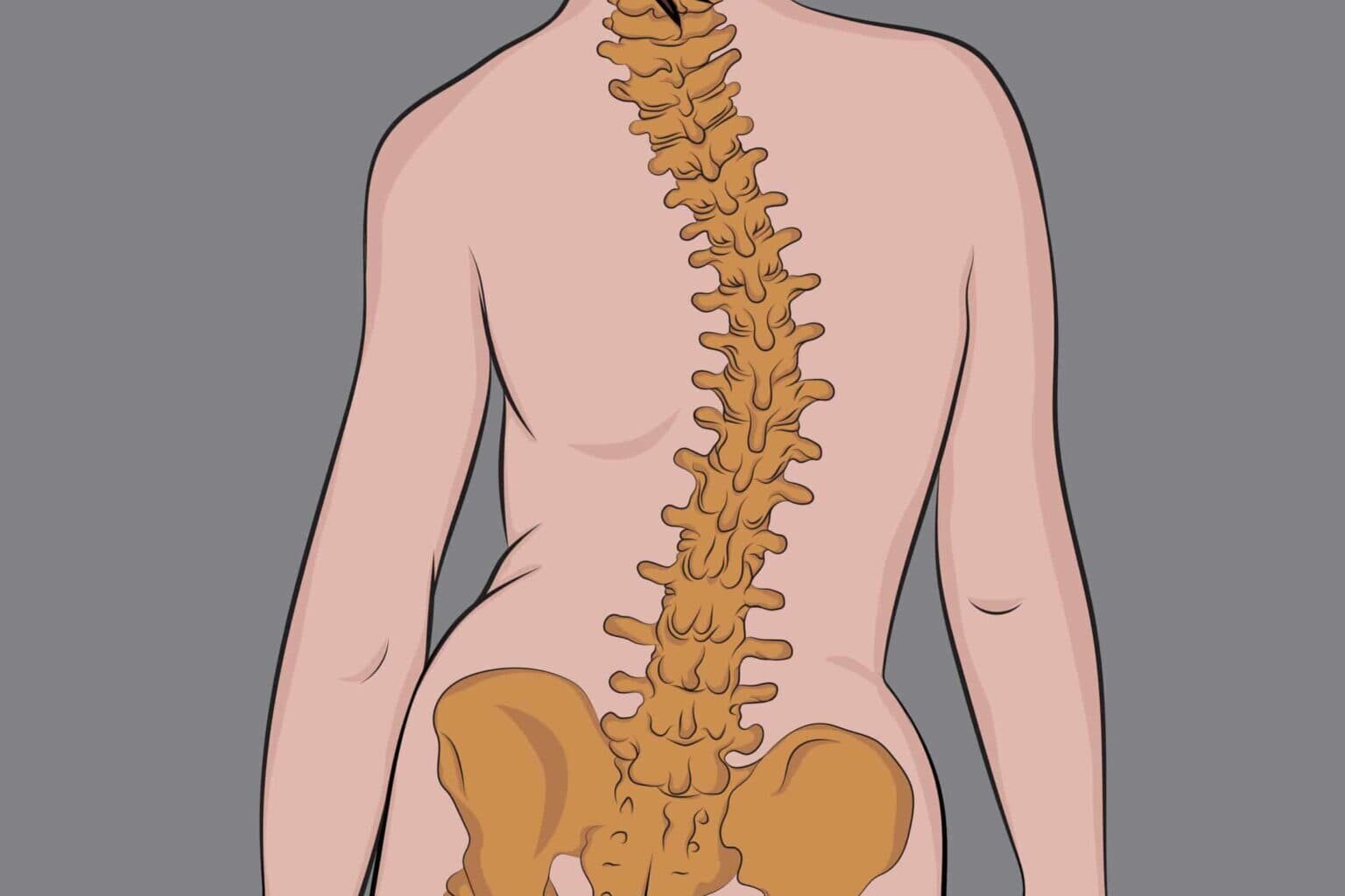 Ilustração da curvatura da coluna vertebral indicando escoliose