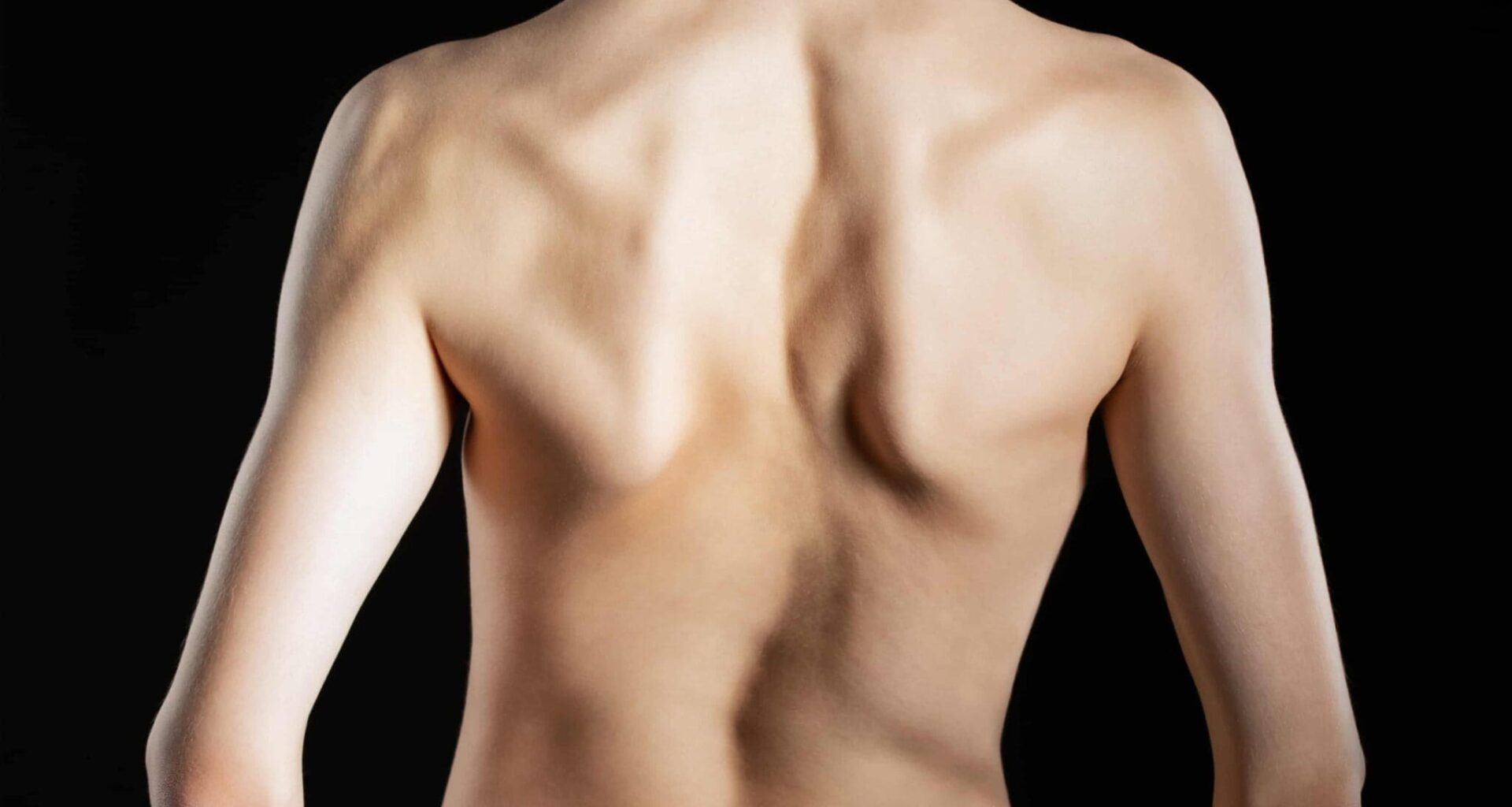 Paciente com desalinhamento postural visível, indicando escoliose em adultos