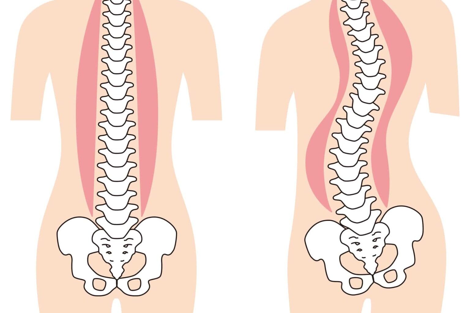 Gráfico comparativo dos sinais físicos que podem evidenciar uma escoliose