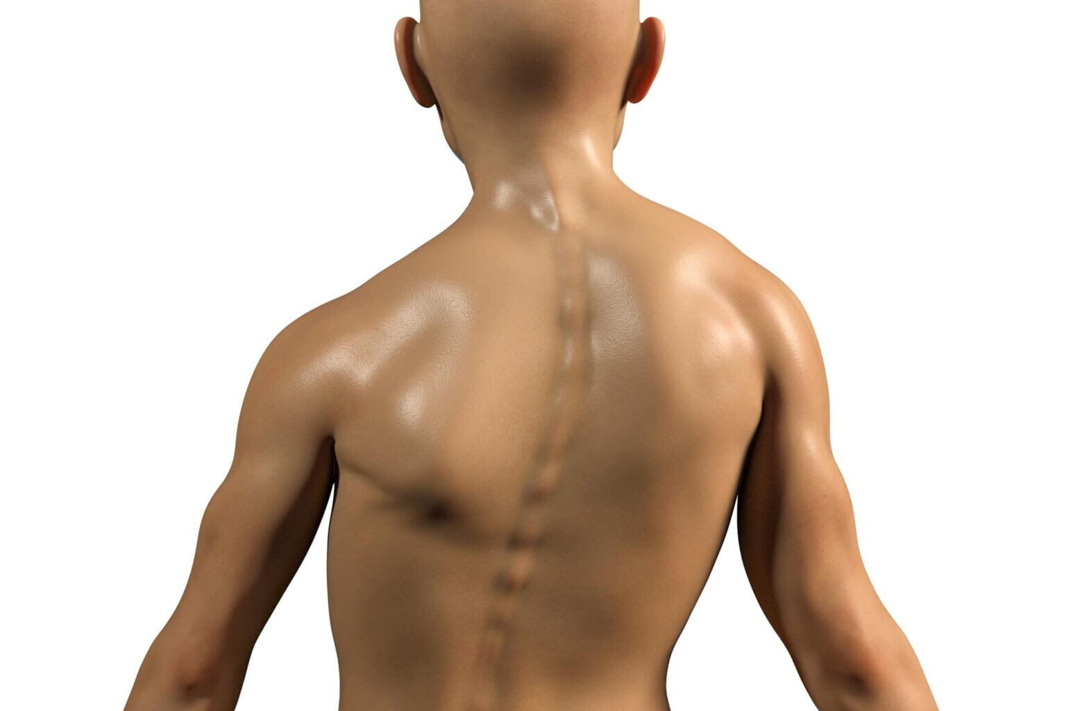 Representação 3D da coluna vertebral com desvio característico da escoliose