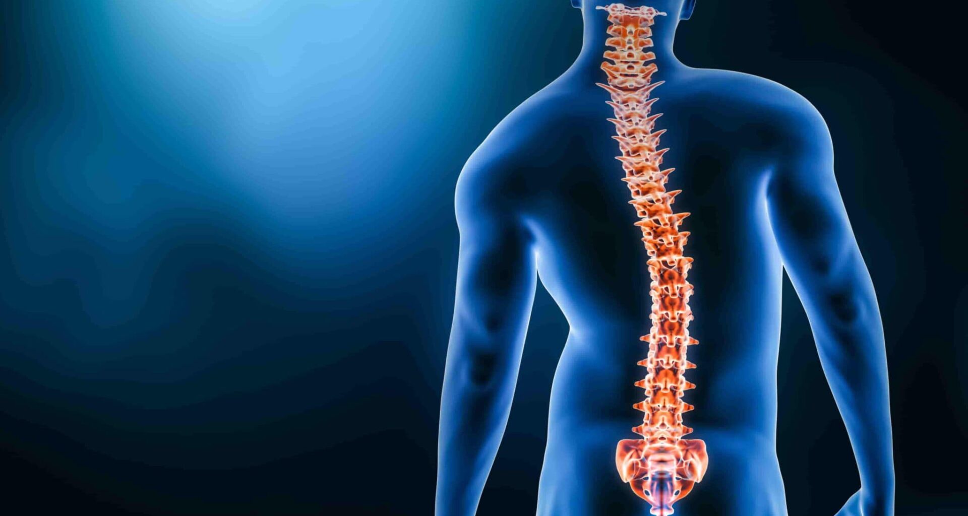 Ilustração do desvio da coluna vertebral típico da escoliose