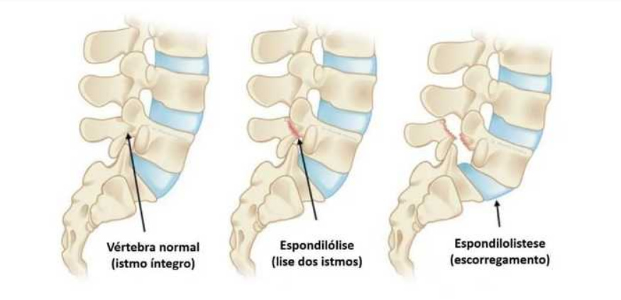 tipos de vértebra