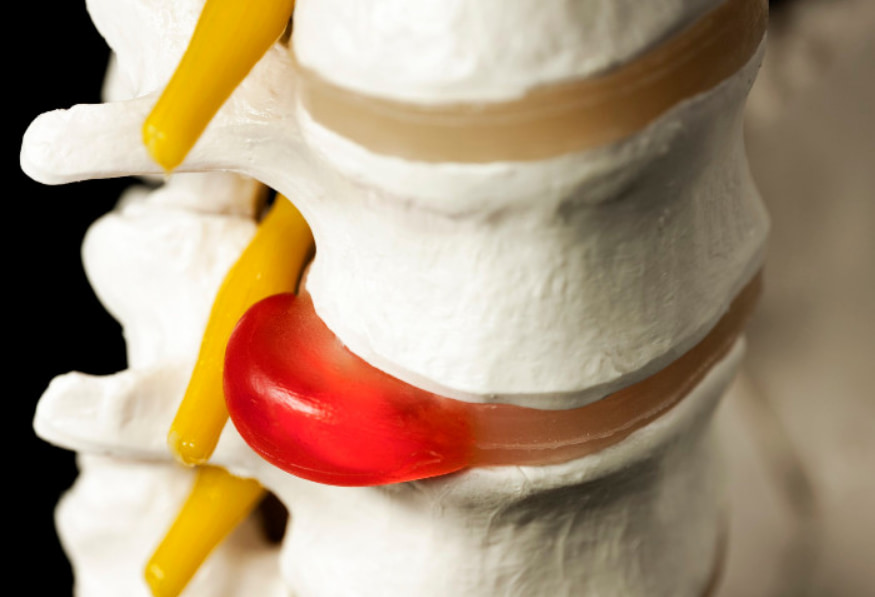 Modelo anatômico de uma coluna vertebral mostrando uma hérnia de disco extrusa, onde o material do disco se projeta e comprime um nervo espinhal amarelo. O modelo ilustra a causa da dor e os sintomas da hérnia de disco lombar.