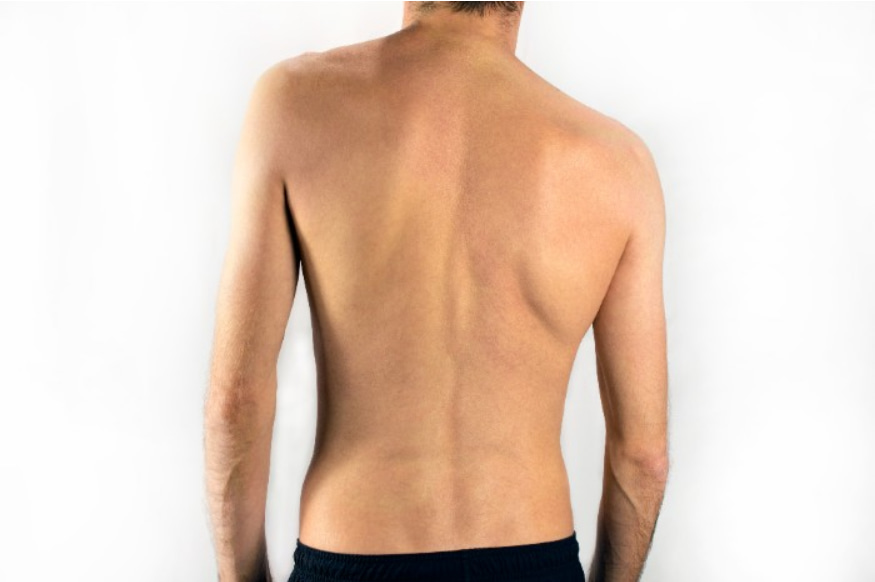 foto de exercícios para escoliose