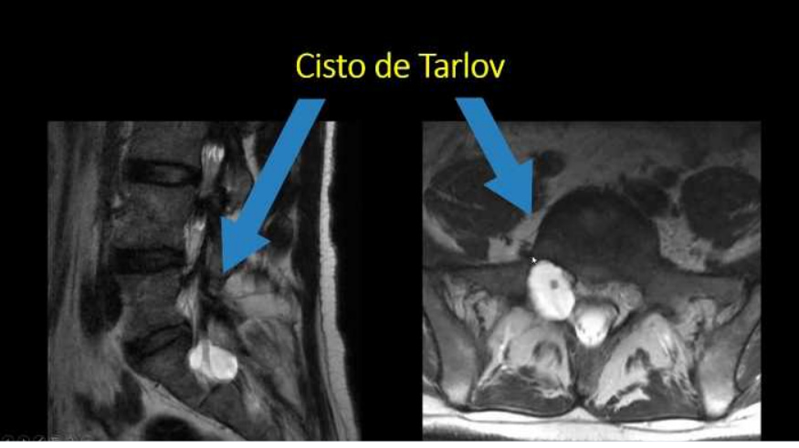exame mostrando cisto de tarlov