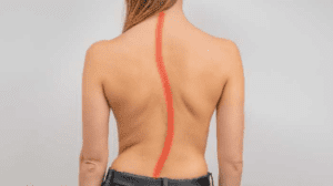 Tipos-de-escoliose-itc-vertebral