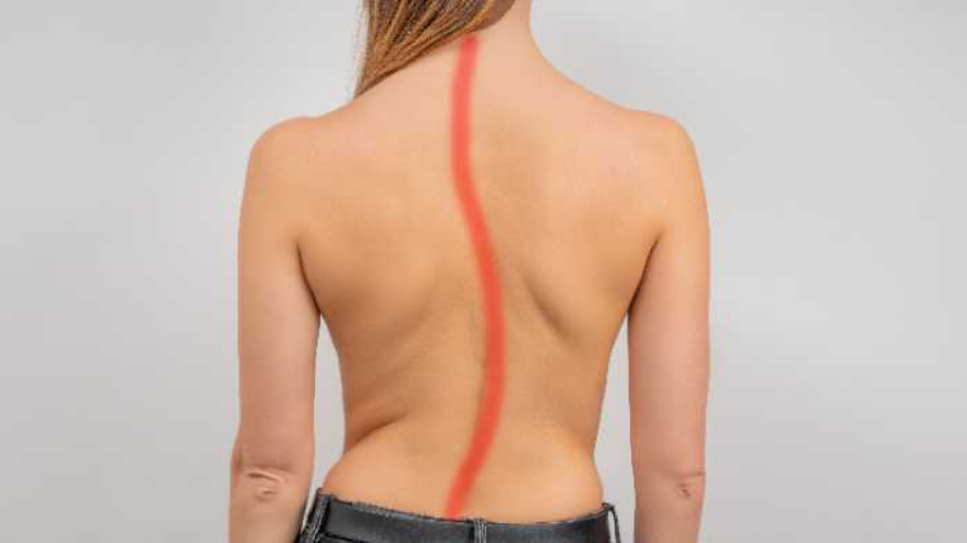 Tipos-de-escoliose-itc-vertebral