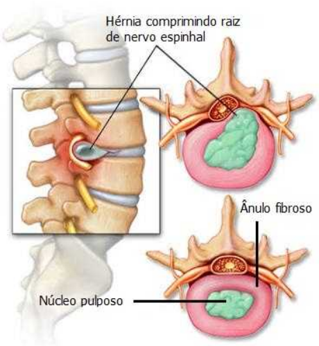 hernia de nucleo pulposo itc vetebral