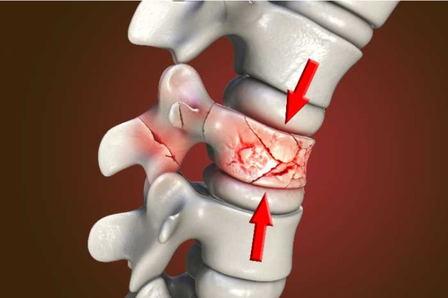esquema de vertebroplastia