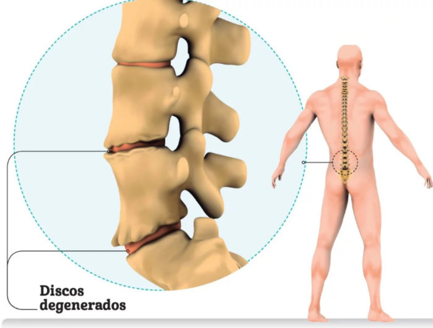 foto de espondilodiscopatia degenerativa
