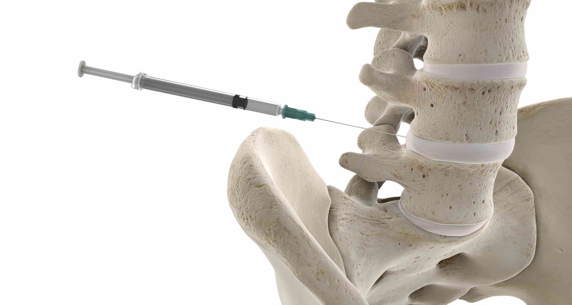 A infiltração foraminal (também conhecida como bloqueio foraminal ou da raiz lombar) é um procedimento minimamente invasivo usado para injetar medicamentos no forame da coluna vertebral.