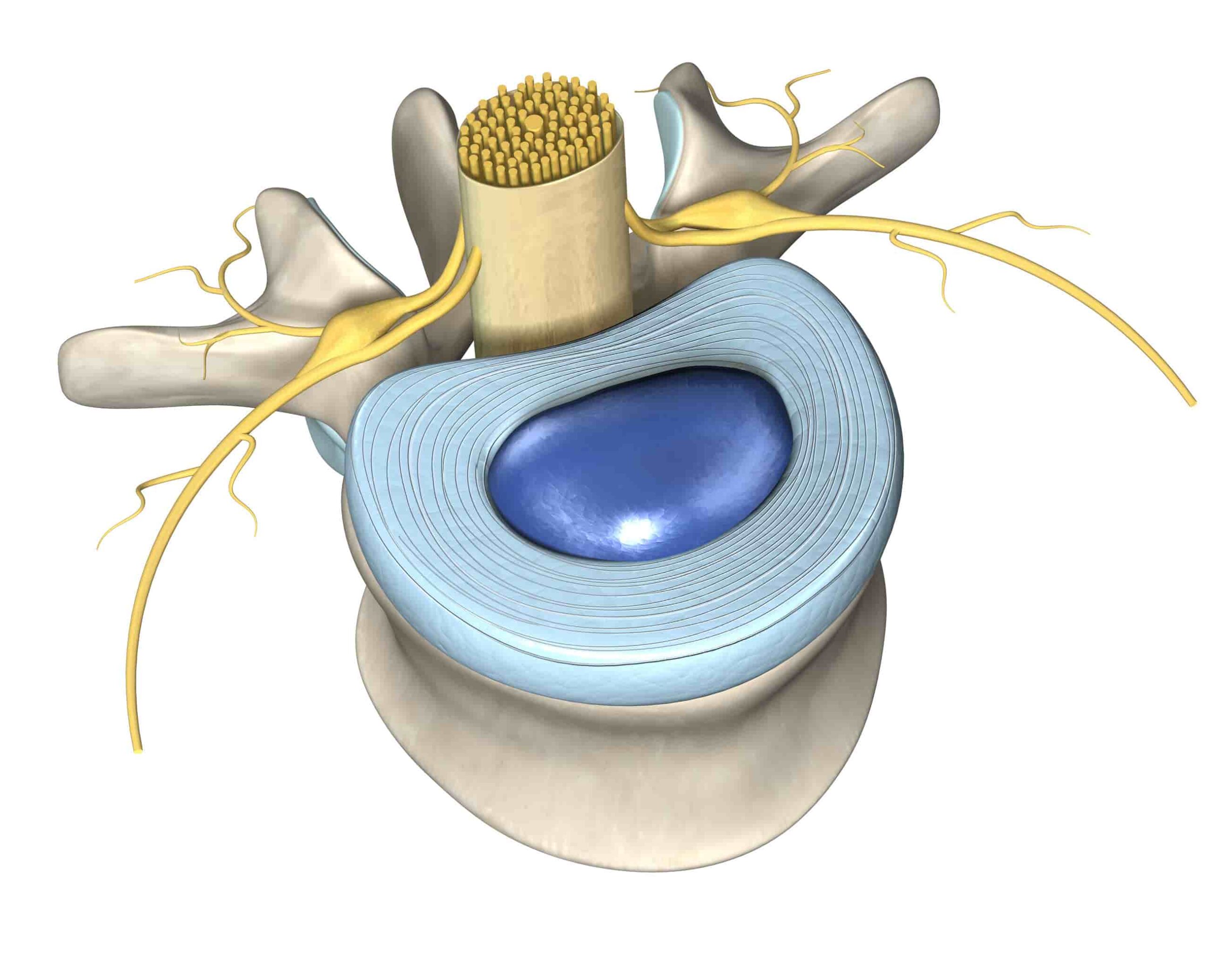 Discos intervertebrais aproximados