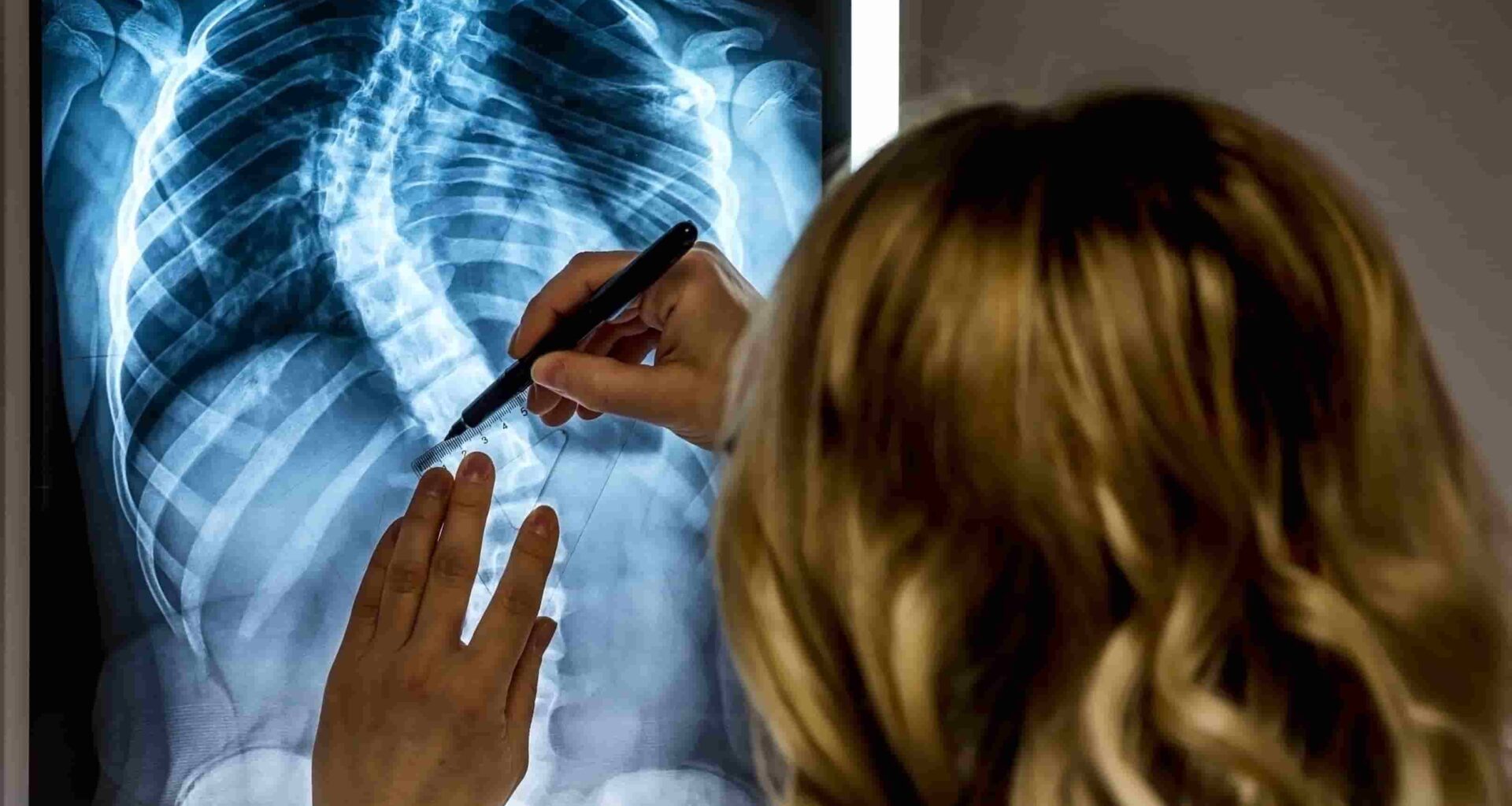 foto de escoliose qual medico procurar