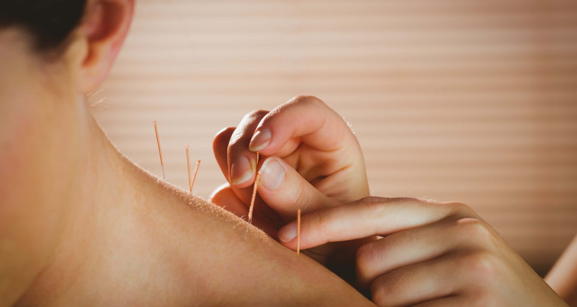 foto de acupuntura