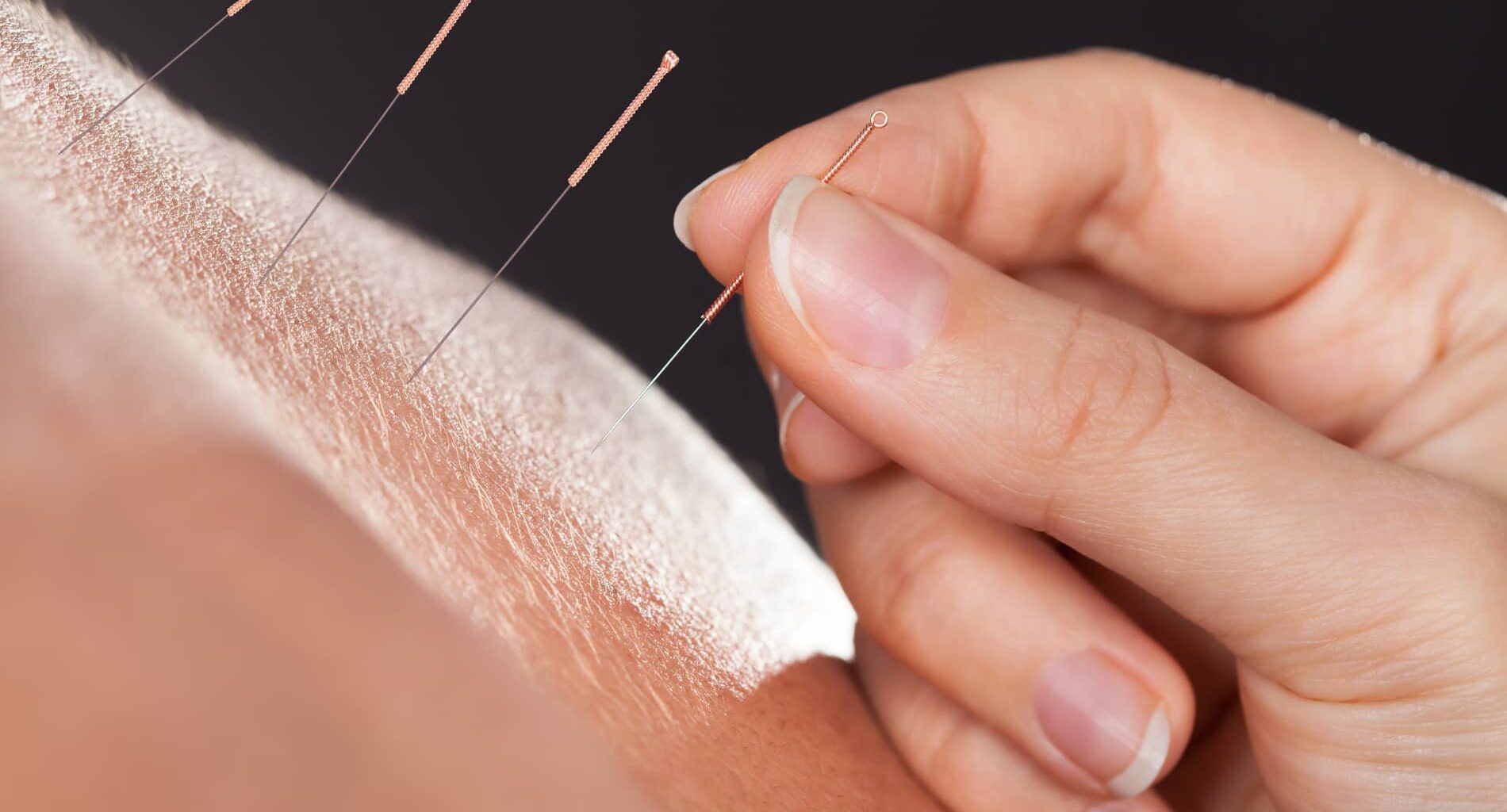 foto de acupuntura para dor nas costas